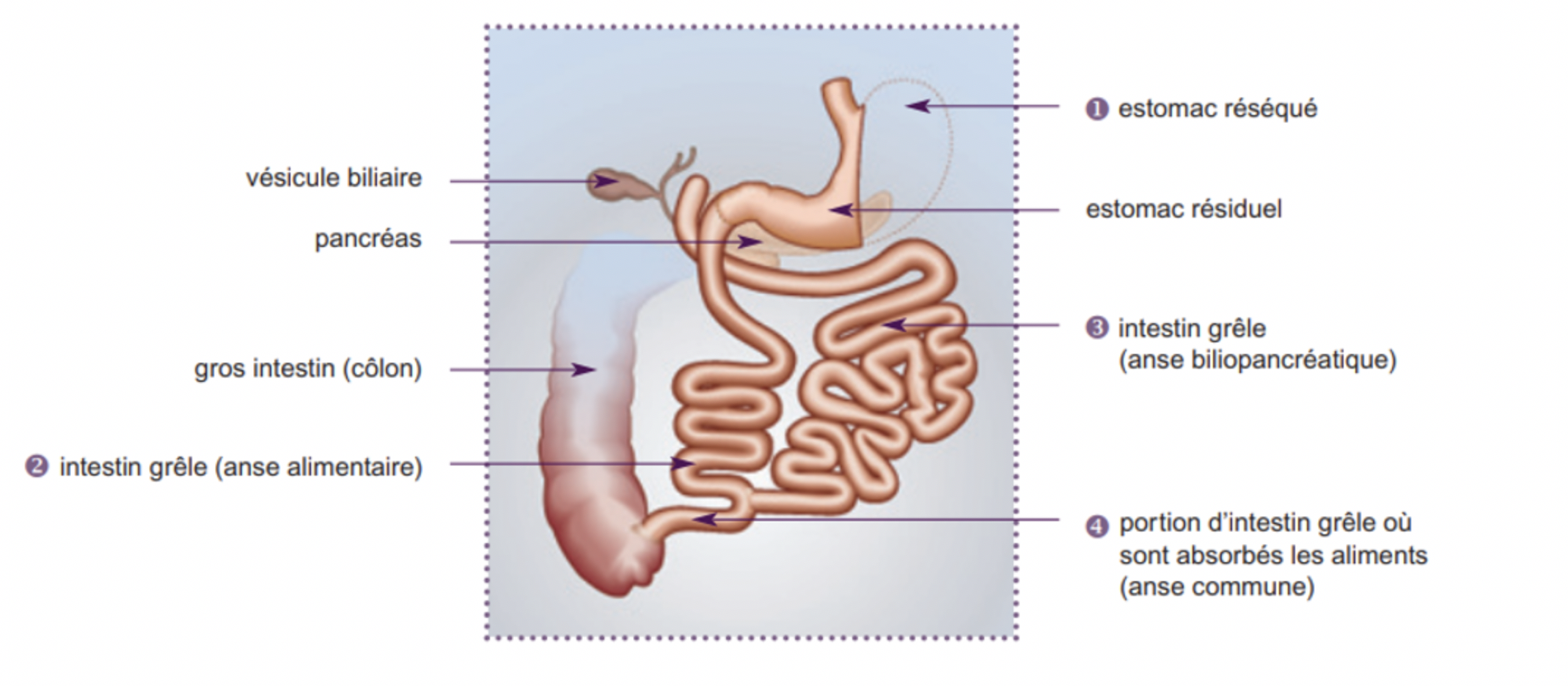 Dérivation biliopancréatique